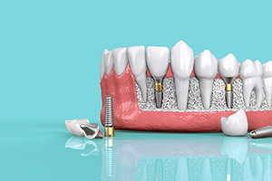 dental_implant_model
